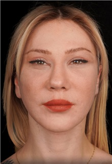 Facelift After Photo by Guncel Ozturk, Assoc. Prof. Dr, FEBOPRAS; Istanbul, M - Case 50983