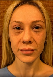 Facelift Before Photo by Guncel Ozturk, Assoc. Prof. Dr, FEBOPRAS; Istanbul, M - Case 50983