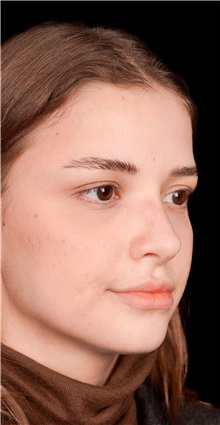 Rhinoplasty After Photo by Guncel Ozturk, Assoc. Prof. Dr, FEBOPRAS; Istanbul, M - Case 50975