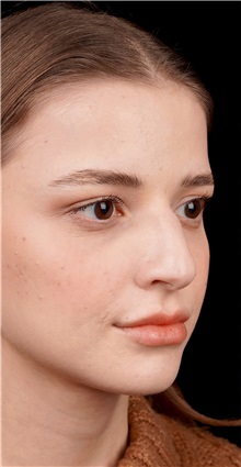 Rhinoplasty Before Photo by Guncel Ozturk, Assoc. Prof. Dr, FEBOPRAS; Istanbul, M - Case 50975