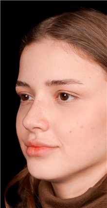 Rhinoplasty After Photo by Guncel Ozturk, Assoc. Prof. Dr, FEBOPRAS; Istanbul, M - Case 50975