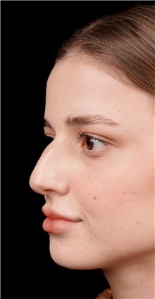 Rhinoplasty Before Photo by Guncel Ozturk, Assoc. Prof. Dr, FEBOPRAS; Istanbul, M - Case 50975