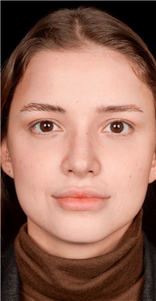 Rhinoplasty After Photo by Guncel Ozturk, Assoc. Prof. Dr, FEBOPRAS; Istanbul, M - Case 50975