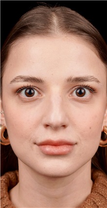 Rhinoplasty Before Photo by Guncel Ozturk, Assoc. Prof. Dr, FEBOPRAS; Istanbul, M - Case 50975