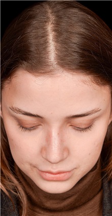Rhinoplasty After Photo by Guncel Ozturk, Assoc. Prof. Dr, FEBOPRAS; Istanbul, M - Case 50975