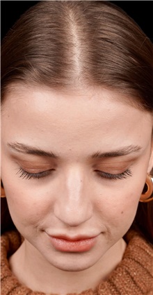 Rhinoplasty Before Photo by Guncel Ozturk, Assoc. Prof. Dr, FEBOPRAS; Istanbul, M - Case 50975
