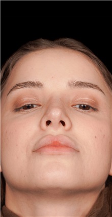 Rhinoplasty After Photo by Guncel Ozturk, Assoc. Prof. Dr, FEBOPRAS; Istanbul, M - Case 50975