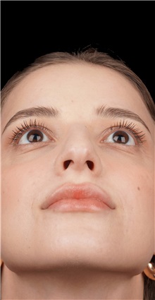 Rhinoplasty Before Photo by Guncel Ozturk, Assoc. Prof. Dr, FEBOPRAS; Istanbul, M - Case 50975