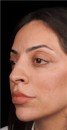 Rhinoplasty Before Photo by Guncel Ozturk, Assoc. Prof. Dr, FEBOPRAS; Istanbul, M - Case 50974