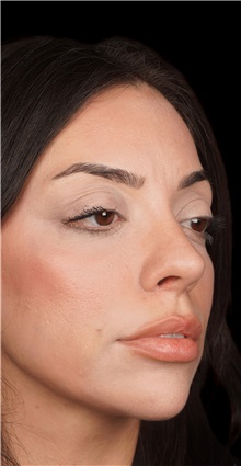Rhinoplasty After Photo by Guncel Ozturk, Assoc. Prof. Dr, FEBOPRAS; Istanbul, M - Case 50974