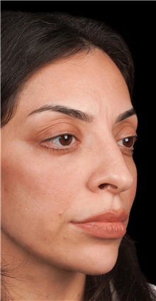 Rhinoplasty Before Photo by Guncel Ozturk, Assoc. Prof. Dr, FEBOPRAS; Istanbul, M - Case 50974
