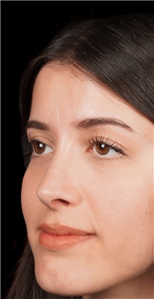 Rhinoplasty After Photo by Guncel Ozturk, Assoc. Prof. Dr, FEBOPRAS; Istanbul, M - Case 50976