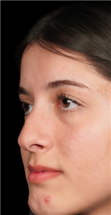 Rhinoplasty Before Photo by Guncel Ozturk, Assoc. Prof. Dr, FEBOPRAS; Istanbul, M - Case 50976
