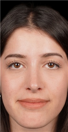 Rhinoplasty After Photo by Guncel Ozturk, Assoc. Prof. Dr, FEBOPRAS; Istanbul, M - Case 50976