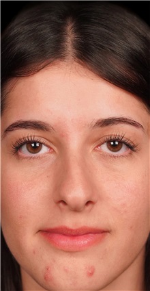 Rhinoplasty Before Photo by Guncel Ozturk, Assoc. Prof. Dr, FEBOPRAS; Istanbul, M - Case 50976