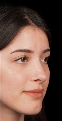 Rhinoplasty After Photo by Guncel Ozturk, Assoc. Prof. Dr, FEBOPRAS; Istanbul, M - Case 50976