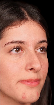 Rhinoplasty Before Photo by Guncel Ozturk, Assoc. Prof. Dr, FEBOPRAS; Istanbul, M - Case 50976