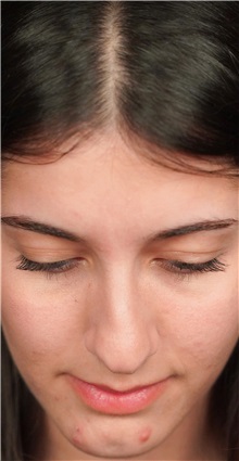 Rhinoplasty Before Photo by Guncel Ozturk, Assoc. Prof. Dr, FEBOPRAS; Istanbul, M - Case 50976