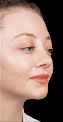Rhinoplasty After Photo by Guncel Ozturk, Assoc. Prof. Dr, FEBOPRAS; Istanbul, M - Case 50978