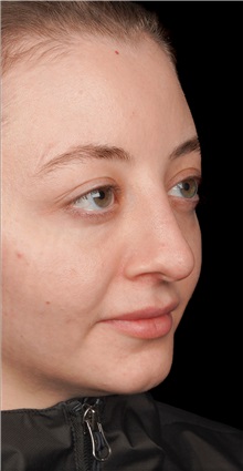 Rhinoplasty Before Photo by Guncel Ozturk, Assoc. Prof. Dr, FEBOPRAS; Istanbul, M - Case 50978