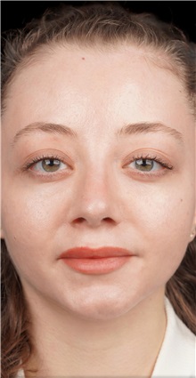 Rhinoplasty After Photo by Guncel Ozturk, Assoc. Prof. Dr, FEBOPRAS; Istanbul, M - Case 50978