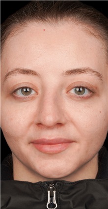 Rhinoplasty Before Photo by Guncel Ozturk, Assoc. Prof. Dr, FEBOPRAS; Istanbul, M - Case 50978