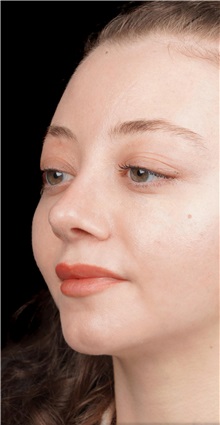 Rhinoplasty After Photo by Guncel Ozturk, Assoc. Prof. Dr, FEBOPRAS; Istanbul, M - Case 50978