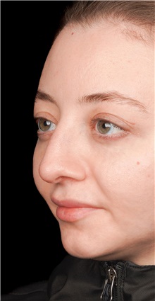Rhinoplasty Before Photo by Guncel Ozturk, Assoc. Prof. Dr, FEBOPRAS; Istanbul, M - Case 50978