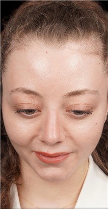Rhinoplasty After Photo by Guncel Ozturk, Assoc. Prof. Dr, FEBOPRAS; Istanbul, M - Case 50978