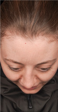 Rhinoplasty Before Photo by Guncel Ozturk, Assoc. Prof. Dr, FEBOPRAS; Istanbul, M - Case 50978