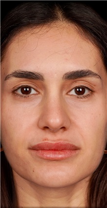 Rhinoplasty After Photo by Guncel Ozturk, Assoc. Prof. Dr, FEBOPRAS; Istanbul, M - Case 50979