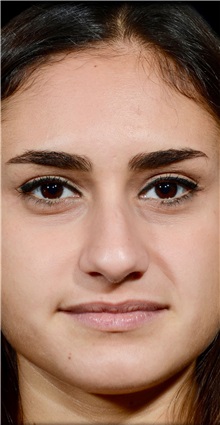 Rhinoplasty Before Photo by Guncel Ozturk, Assoc. Prof. Dr, FEBOPRAS; Istanbul, M - Case 50979