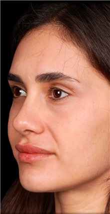 Rhinoplasty After Photo by Guncel Ozturk, Assoc. Prof. Dr, FEBOPRAS; Istanbul, M - Case 50979