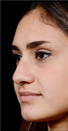 Rhinoplasty Before Photo by Guncel Ozturk, Assoc. Prof. Dr, FEBOPRAS; Istanbul, M - Case 50979
