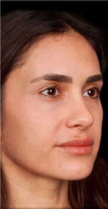 Rhinoplasty After Photo by Guncel Ozturk, Assoc. Prof. Dr, FEBOPRAS; Istanbul, M - Case 50979