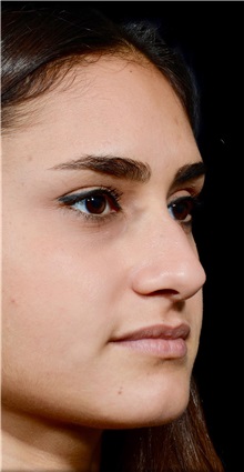 Rhinoplasty Before Photo by Guncel Ozturk, Assoc. Prof. Dr, FEBOPRAS; Istanbul, M - Case 50979