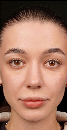 Rhinoplasty After Photo by Guncel Ozturk, Assoc. Prof. Dr, FEBOPRAS; Istanbul, M - Case 50977