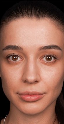 Rhinoplasty Before Photo by Guncel Ozturk, Assoc. Prof. Dr, FEBOPRAS; Istanbul, M - Case 50977