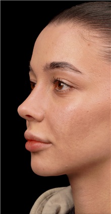Rhinoplasty After Photo by Guncel Ozturk, Assoc. Prof. Dr, FEBOPRAS; Istanbul, M - Case 50977