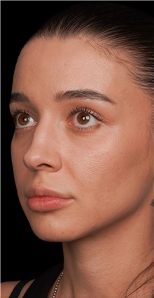 Rhinoplasty Before Photo by Guncel Ozturk, Assoc. Prof. Dr, FEBOPRAS; Istanbul, M - Case 50977