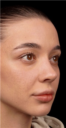 Rhinoplasty After Photo by Guncel Ozturk, Assoc. Prof. Dr, FEBOPRAS; Istanbul, M - Case 50977