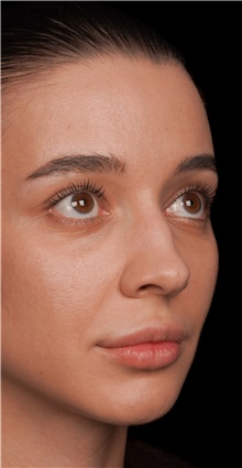 Rhinoplasty Before Photo by Guncel Ozturk, Assoc. Prof. Dr, FEBOPRAS; Istanbul, M - Case 50977