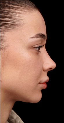 Rhinoplasty After Photo by Guncel Ozturk, Assoc. Prof. Dr, FEBOPRAS; Istanbul, M - Case 50977