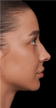 Rhinoplasty Before Photo by Guncel Ozturk, Assoc. Prof. Dr, FEBOPRAS; Istanbul, M - Case 50977