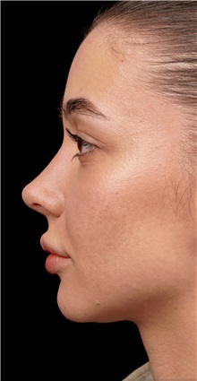 Rhinoplasty After Photo by Guncel Ozturk, Assoc. Prof. Dr, FEBOPRAS; Istanbul, M - Case 50977