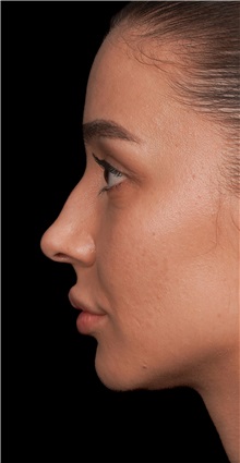 Rhinoplasty Before Photo by Guncel Ozturk, Assoc. Prof. Dr, FEBOPRAS; Istanbul, M - Case 50977
