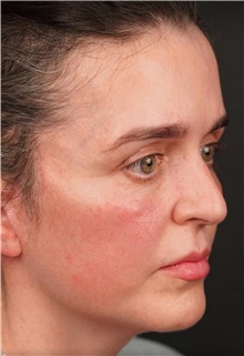 Facelift After Photo by Guncel Ozturk, Assoc. Prof. Dr, FEBOPRAS; Istanbul, M - Case 50984