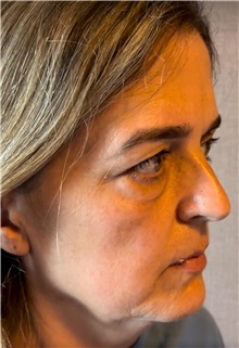 Facelift Before Photo by Guncel Ozturk, Assoc. Prof. Dr, FEBOPRAS; Istanbul, M - Case 50984