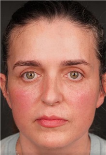 Facelift After Photo by Guncel Ozturk, Assoc. Prof. Dr, FEBOPRAS; Istanbul, M - Case 50984