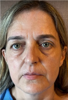 Facelift Before Photo by Guncel Ozturk, Assoc. Prof. Dr, FEBOPRAS; Istanbul, M - Case 50984
